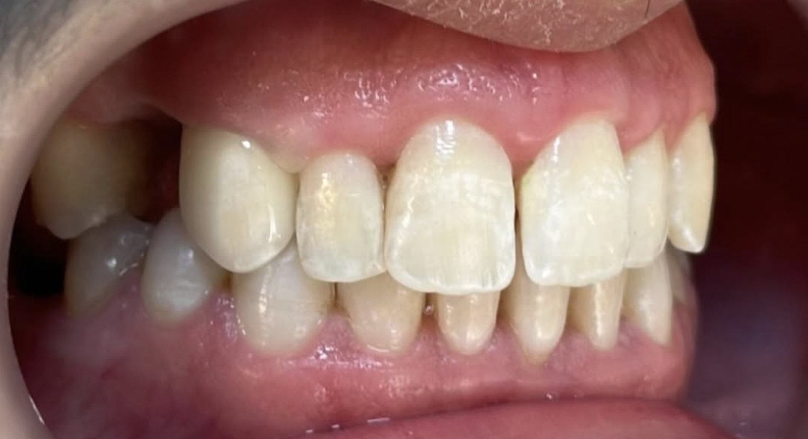 Sourire après le soin esthétique, cas 01